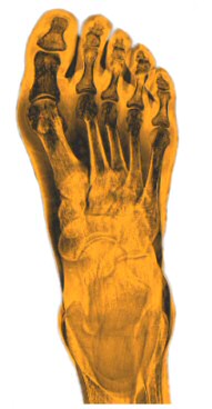 average person takes 18'000 steps, sustaining thousands of kilos of pressure on the 26 bones in their feet.  constant compression may cause pain discomfort fatigue. Over time serious disorders like arthritis heel spurs Plantar Fasciitis practically cripple many people